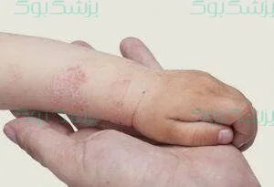 pezeshkbook.com - پزشک‌بوک - آموکسی سیلین 