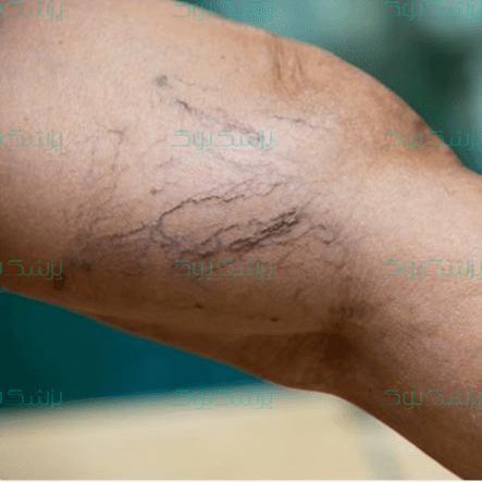 واریس؛ چرا واریس می‌گیریم؟