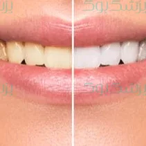 چطور دندانهایمان را سفید کنیم؟