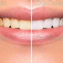 چطور دندانهایمان را سفید کنیم؟