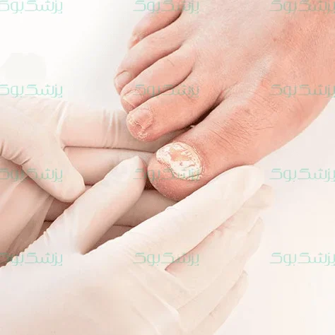 ناخن در گوشت فرو رفته را چگونه درمان کنم؟
