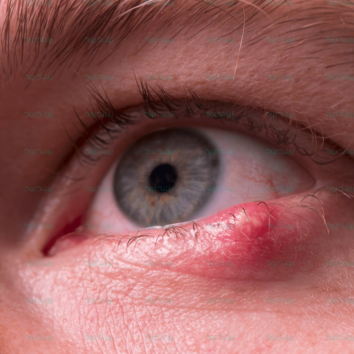 آیا همه گل مژه ها خطرناکند؟ علت ها و درمان گل مژه