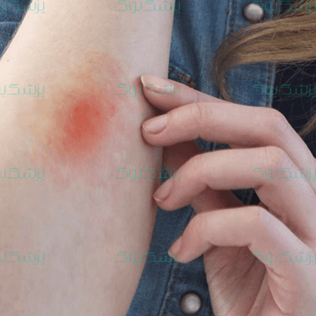 کدام سوختگی در خانه قابل درمان است؟