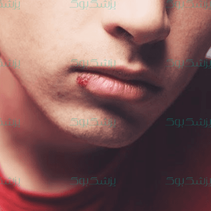 سریعترین روش درمان تبخال لب, علت ایجاد و داروی درمان