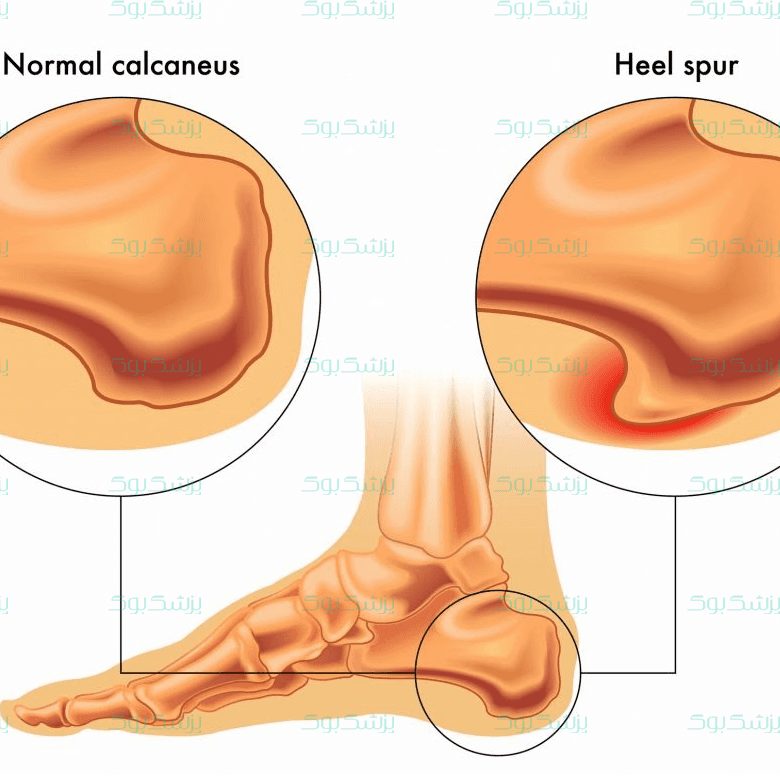 تشخیص علائم و روشهای درمان خار پاشنه