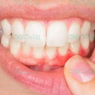 التهاب لثه