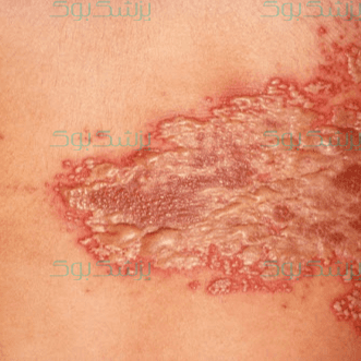 اگر آبله مرغان بگیریم، زونا نمیگیریم؟!