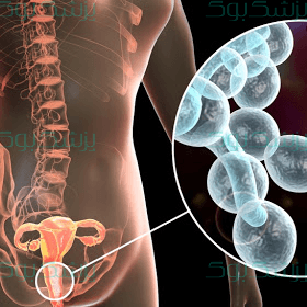 برای جلوگیری از عفونت واژن چه کنیم؟