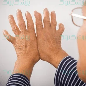 روماتیسم مفصلی؛ عوامل خطر و راههای درمان آن