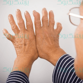 روماتیسم مفصلی؛ عوامل خطر و راههای درمان آن